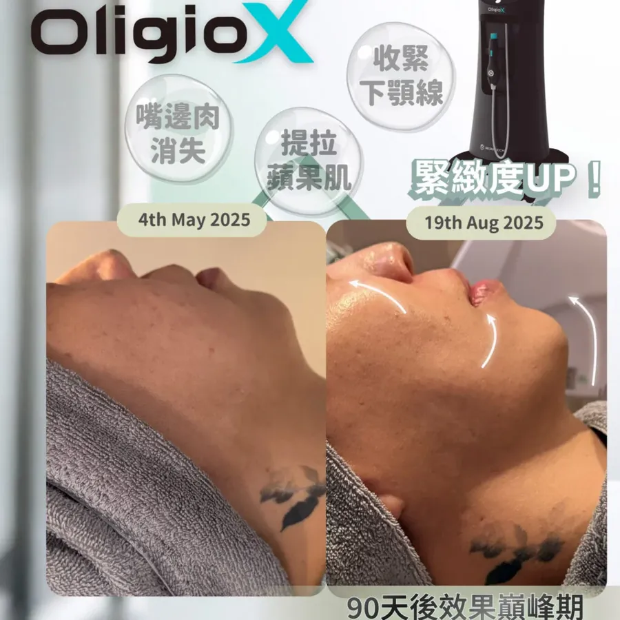 Oligio X 療程前後對照圖，標示 2025 年 5 月 4 日與 8 月 19 日兩個日期