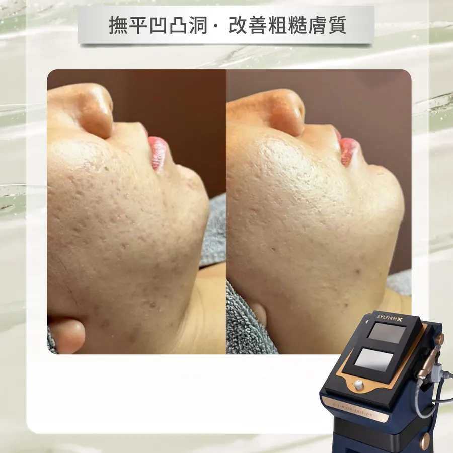 療程前後對照，標示撫平凹凸洞、改善粗糙膚質