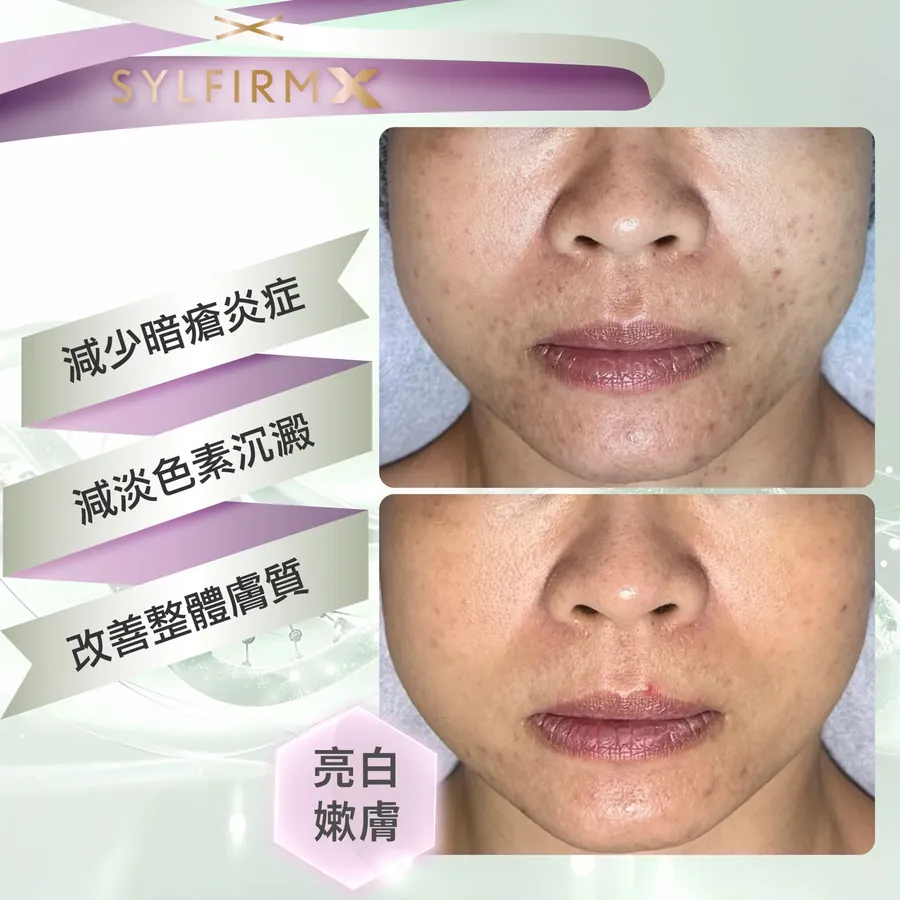SYLFIRM X 療程前後對照，標示減少暗瘡炎症、減淡色素沉澱