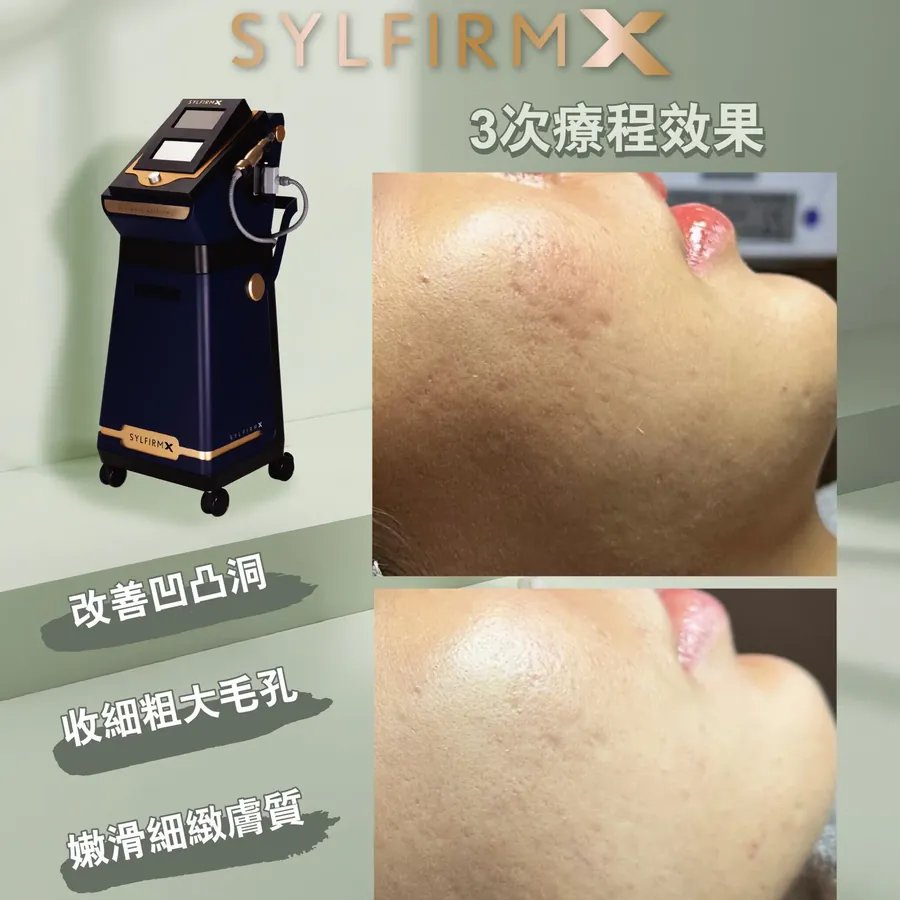 SYLFIRM X 三次療程效果對照，標示改善凹凸洞、收縮粗大毛孔