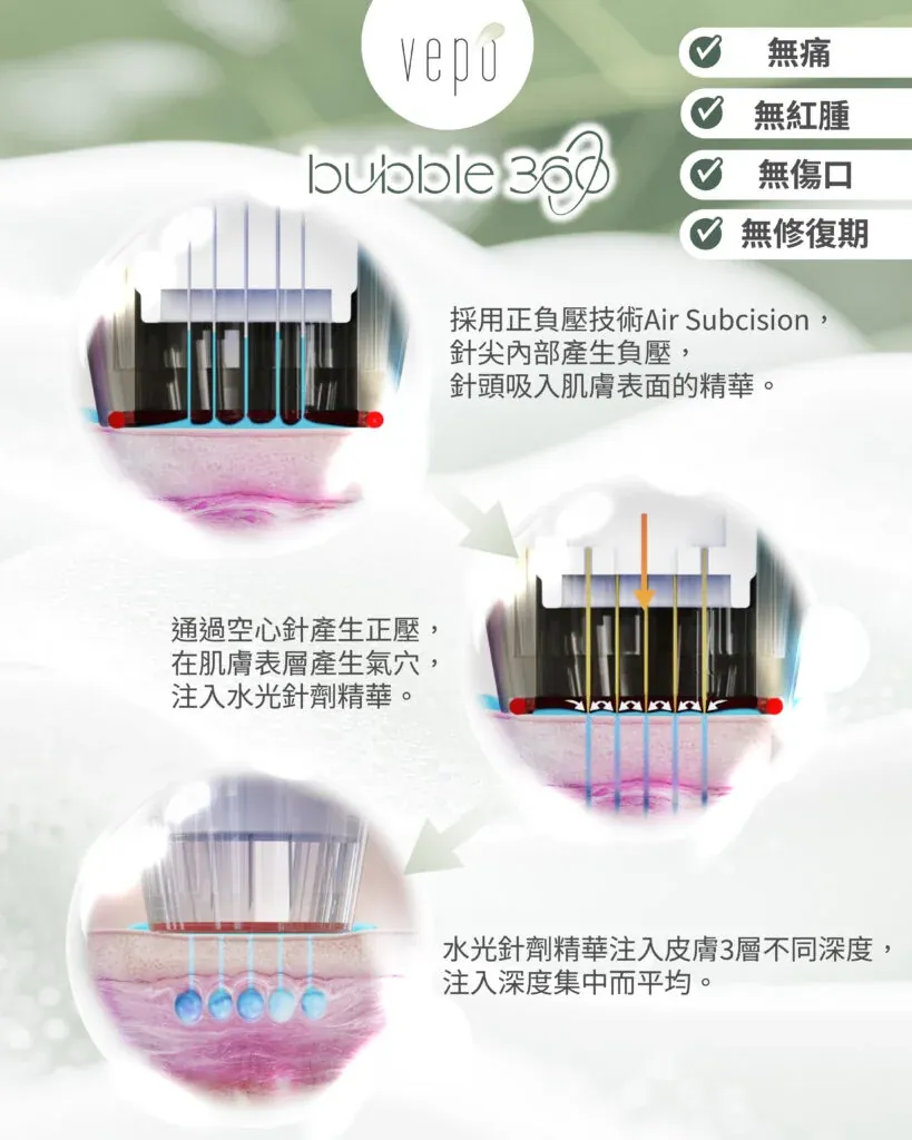 Bubble 360 正負壓 Air Subcision 導入方式說明圖